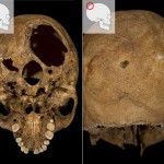trauma on the skull of Richard III
